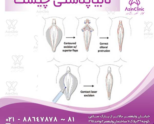 لابیاپلاستی چیست